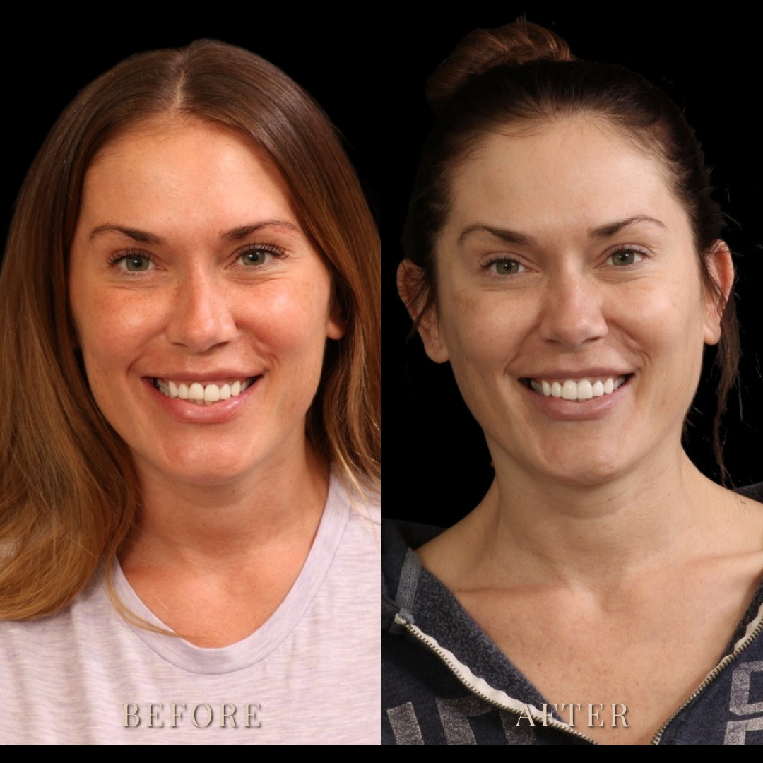 Smile Transformations | The Houston Dentists